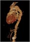 3D CT Angiography Image of Aortic Arch Aneurysm