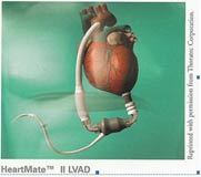 Ventricular Assist Device (VAD) Program at the Division of Cardiothoracic Surgery, SUNY Downstate Medical Center